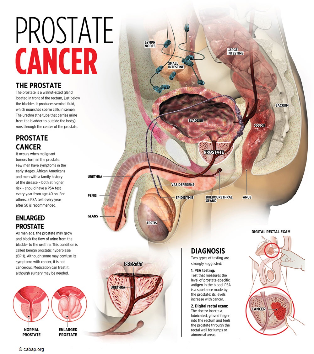 Risultati immagini per prostate cancer