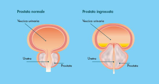 Ipertrofia prostatica - Prostata adenoma mediano. Urológia uroprostatitis kezelési taktikája
