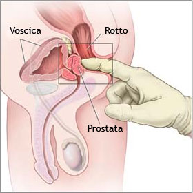 tumore prostata sintomi metastasi)